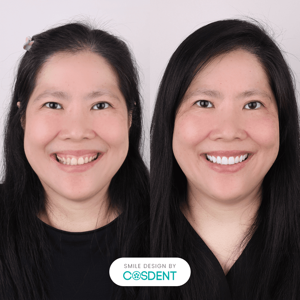 หน้ารูปลูกแพร์ ยิ้มกว้าง 16 ซี่