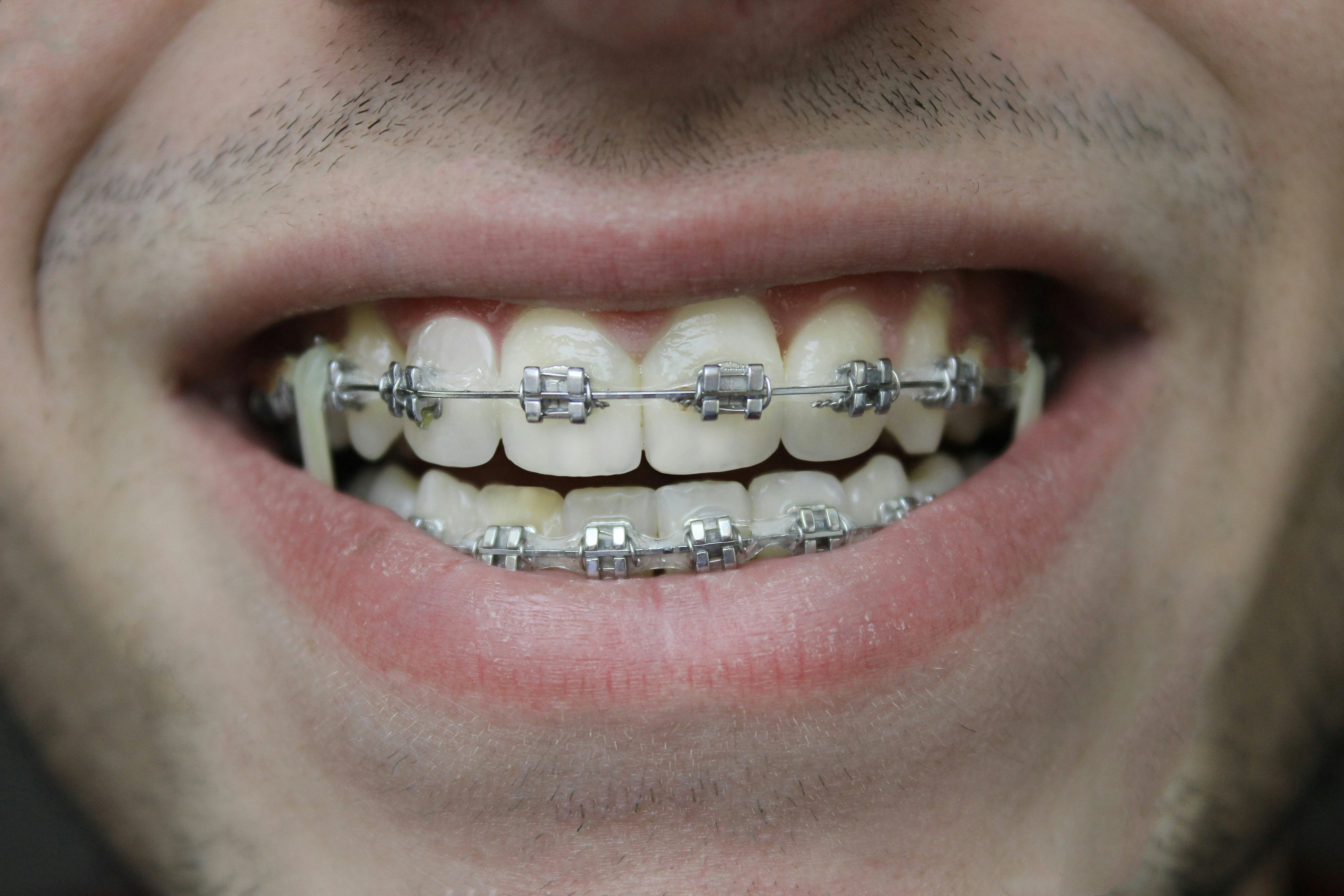 Damon Self-Ligating Braces System COSDENT Bangkok