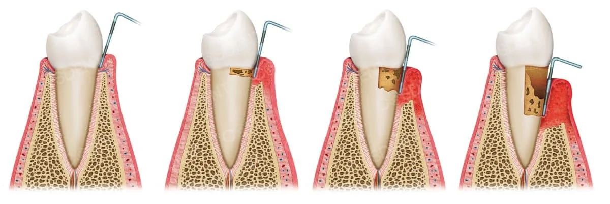 Professional ultrasonic scaling and Airflow stain removal at COSDENT Smile Design