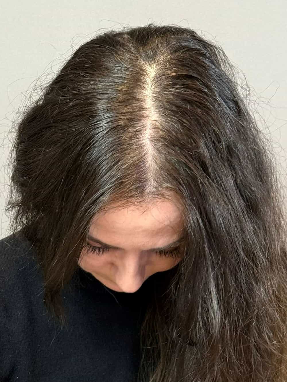 Haarpigmentierung Mann Vorher | Scalp Couple