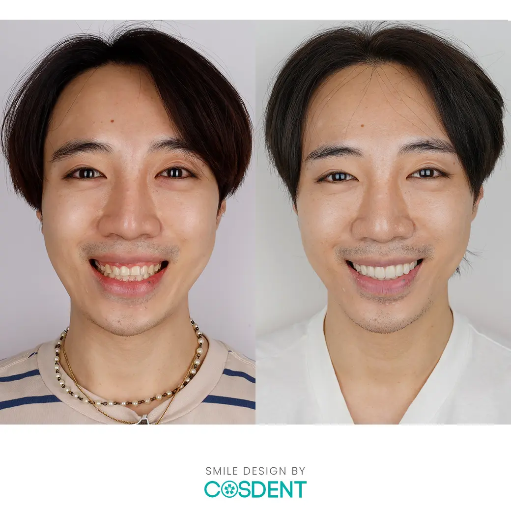 เคสทำวีเนียร์ หมอเช็ค cosdent smile design