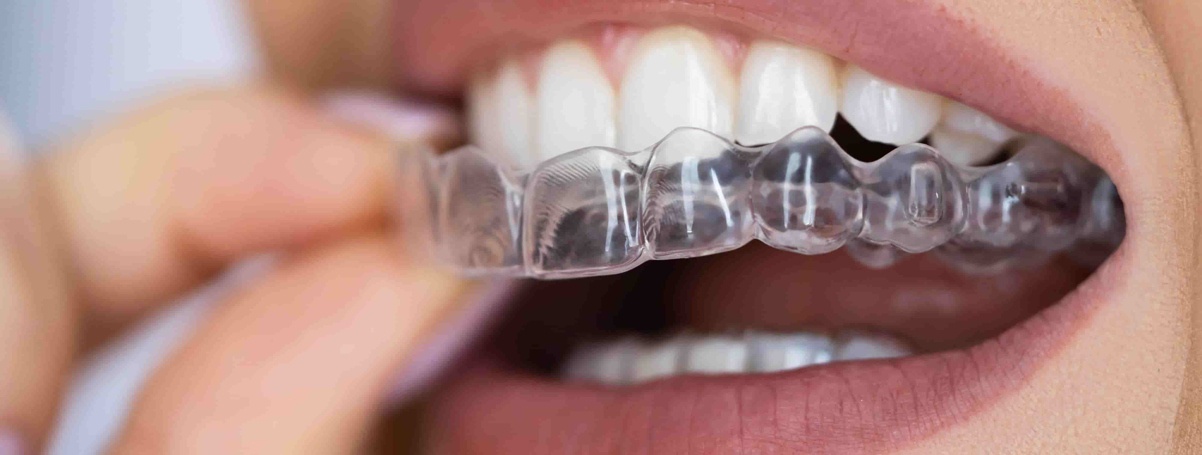invisalign colac