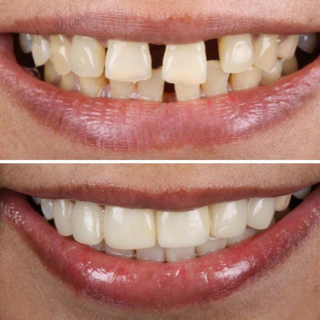 Smiling person with braces and wavy hair.