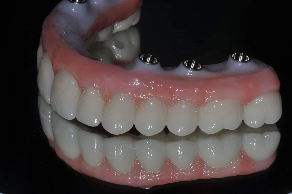 smyrna dental implants
