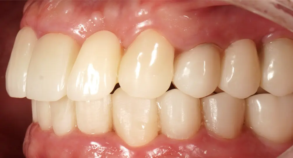 After ortho treatment