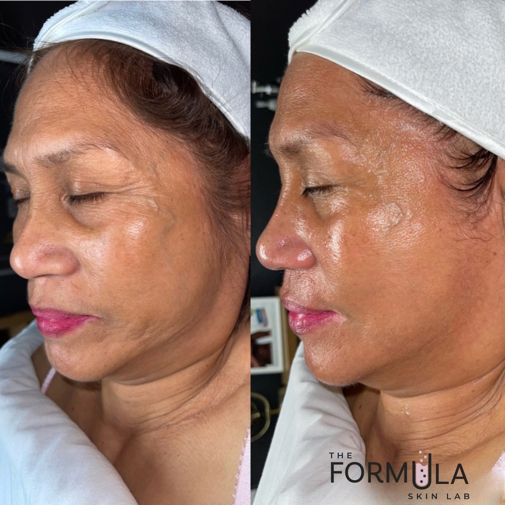 best-firm-and-lift-facial-san-diego-ca