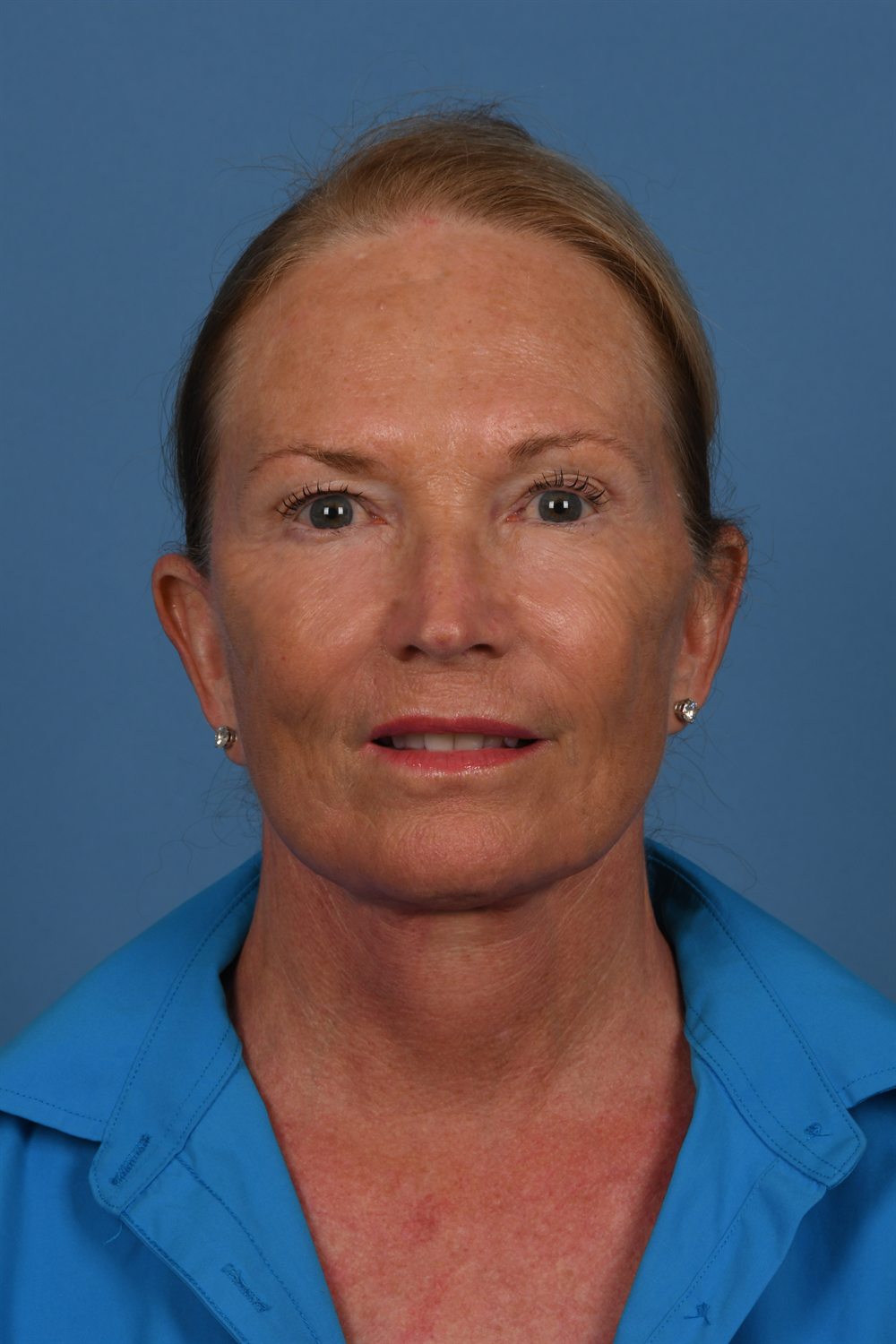 Facelift patient after surgery, front, relaxed