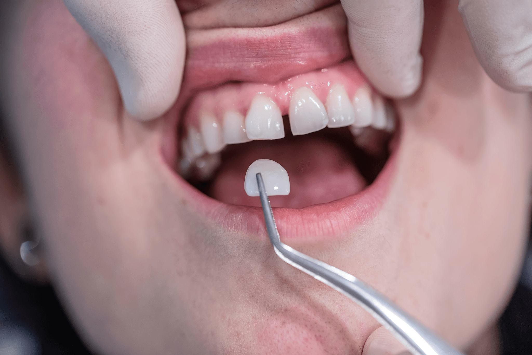 Dentist matching a Lumineer veneer shade to a patient’s natural teeth