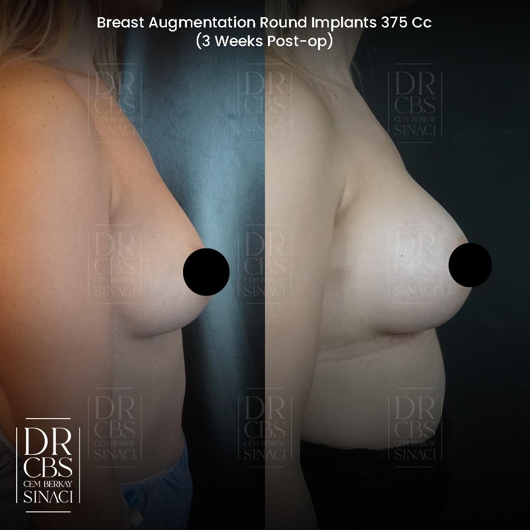 20 days breast implant surgery result side view