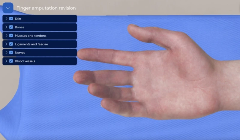 Traumatic finger amputation revision