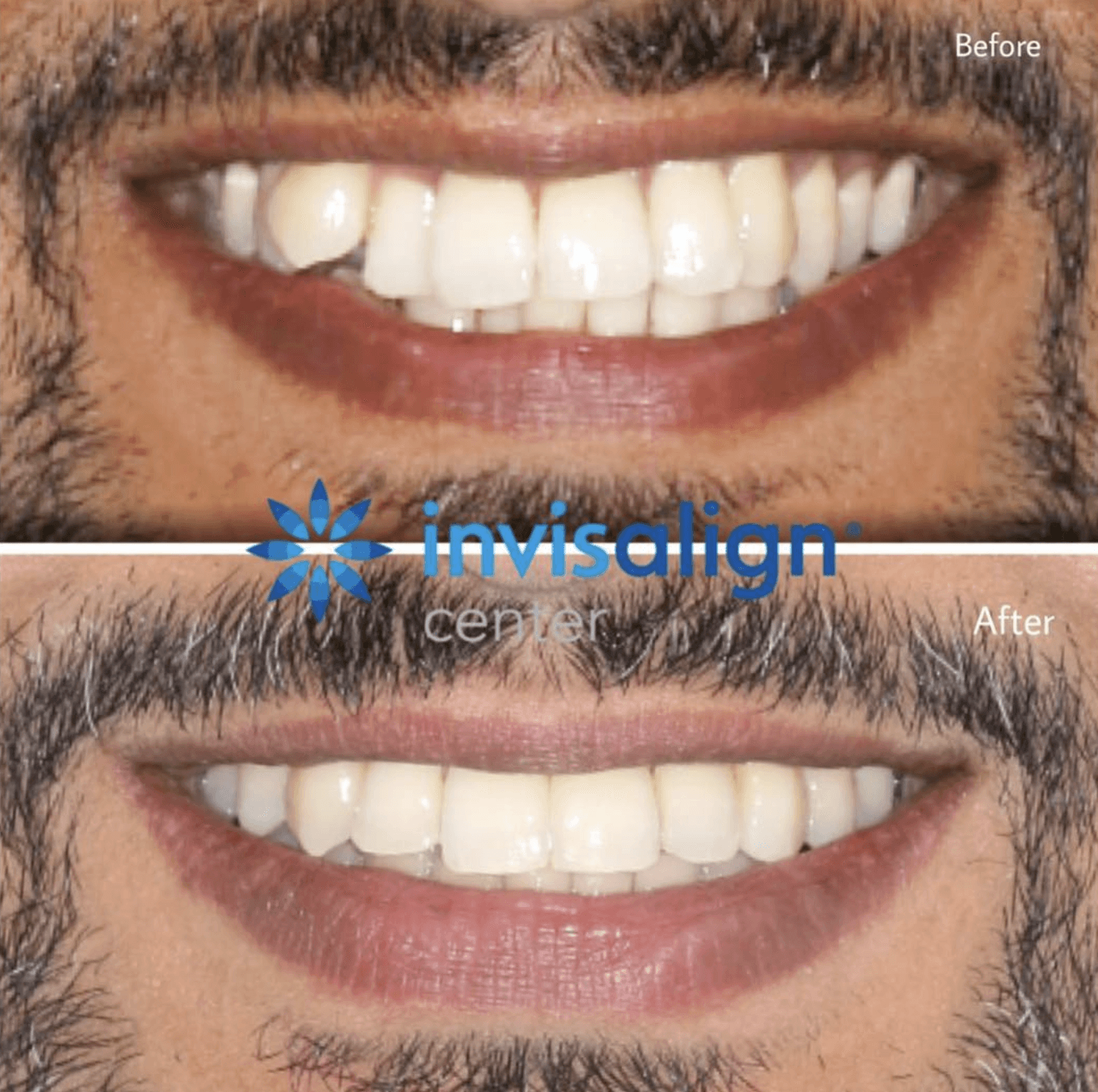 A close-up invisalign before and after photo of teeth corrected from misaligned to a straight smile at Invisalign Center in Dubai