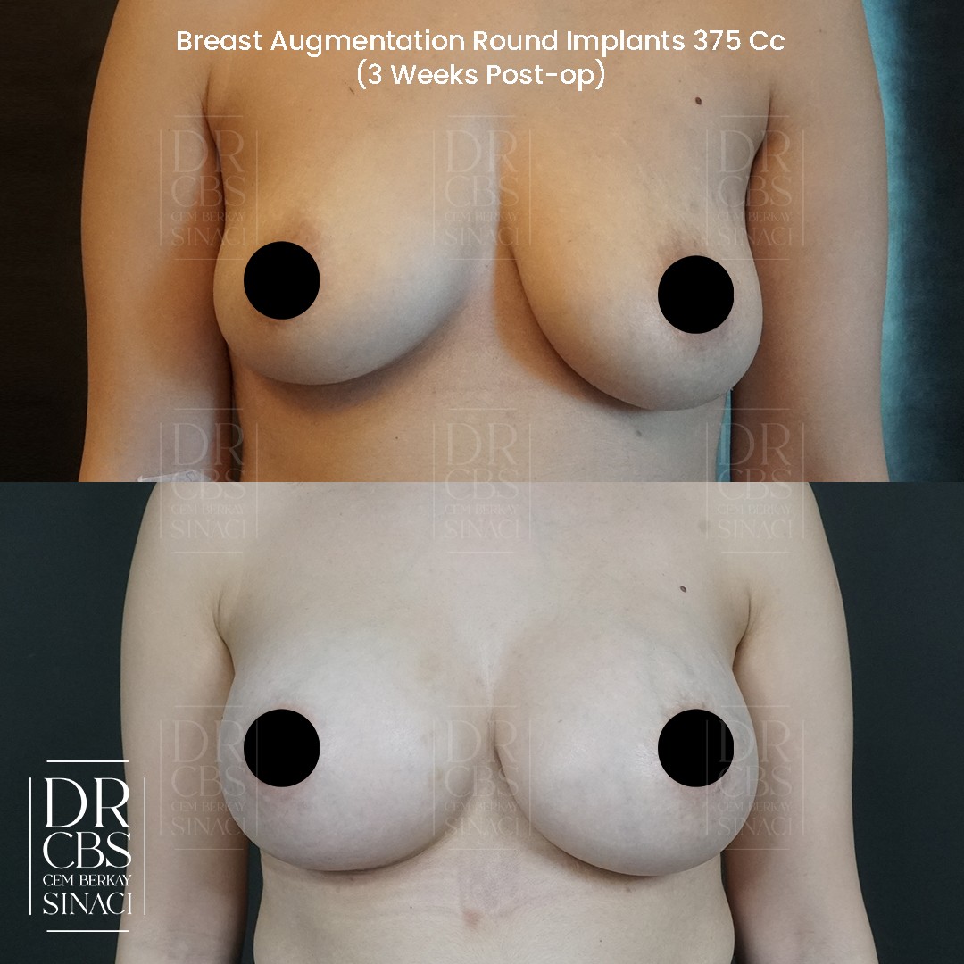 20 days breast implant surgery result front view