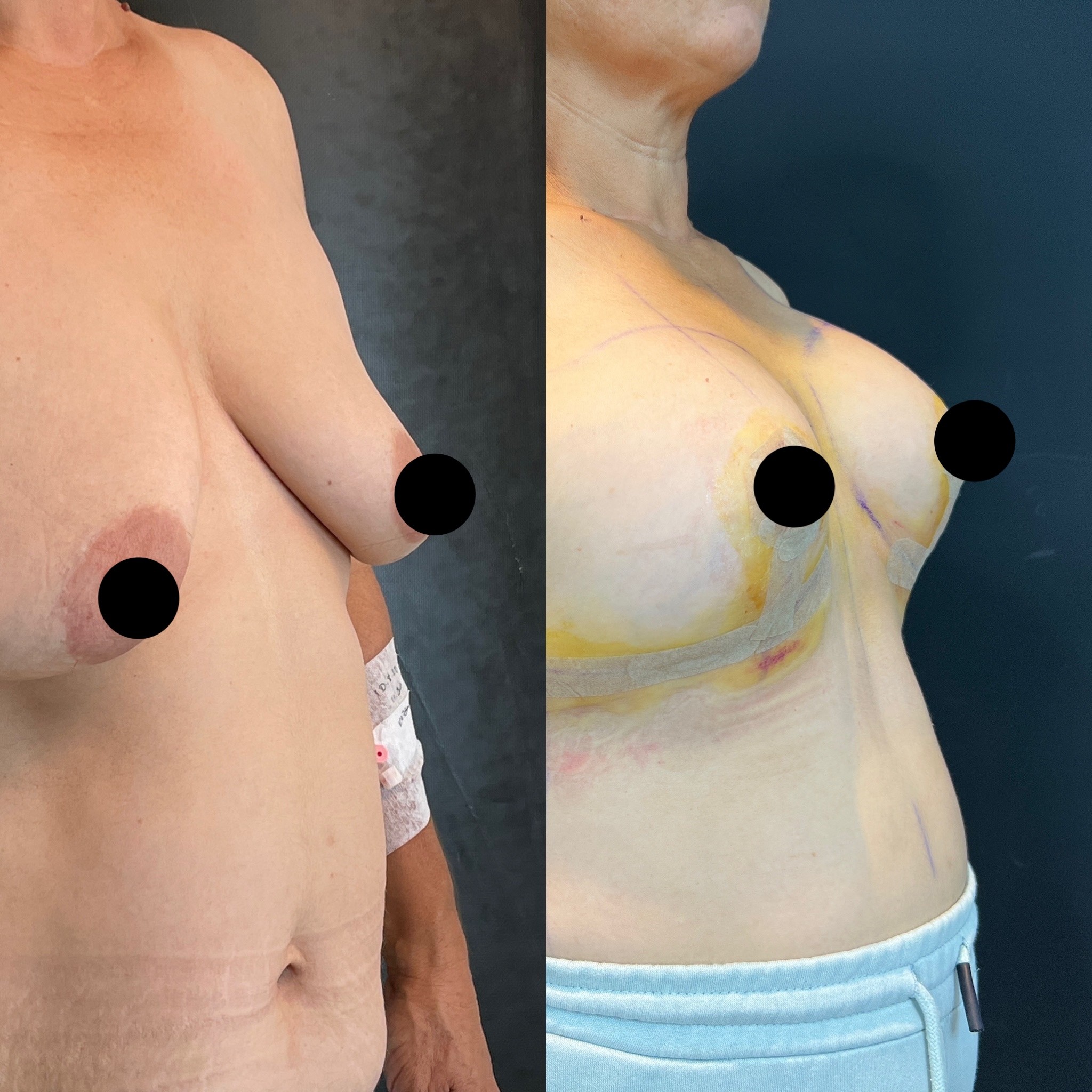 tuberous breast before after tubular breast right oblique view