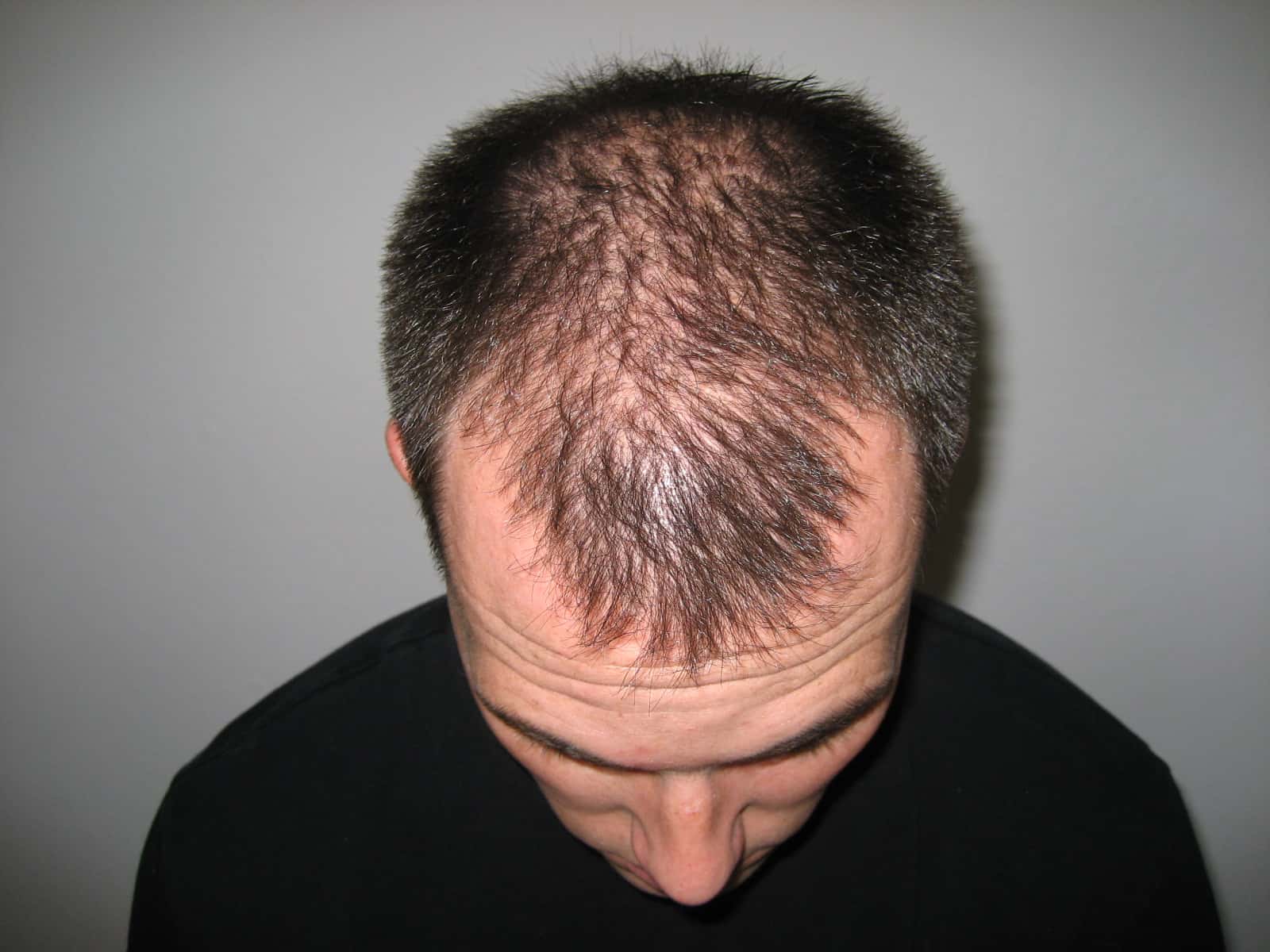 man with hair loss issue - Nofap Hair Loss