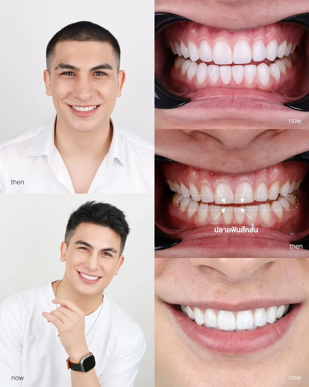Portraits and close-up photographs comparing a man's smile before and after dental treatment.