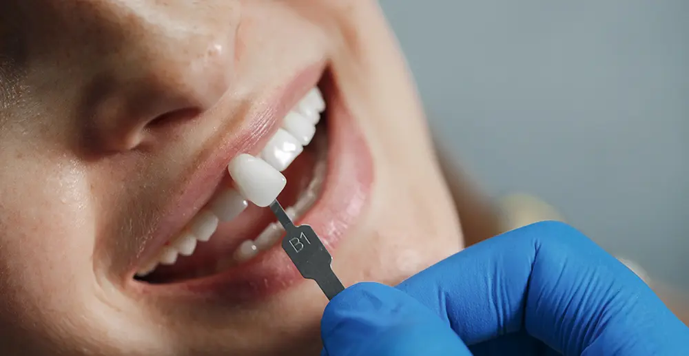 Treatments for a broken tooth