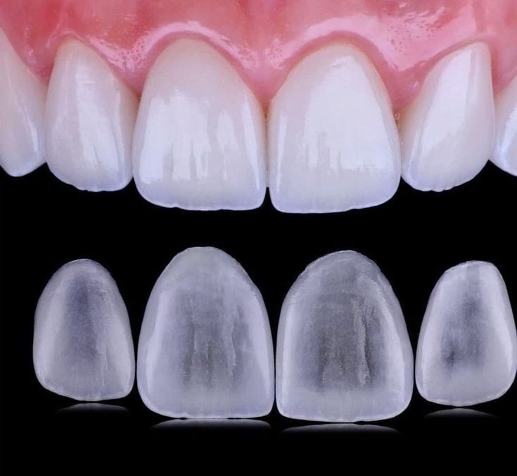 veneers