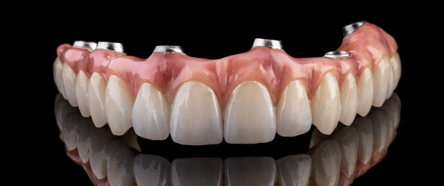 all-on-4 dental implants