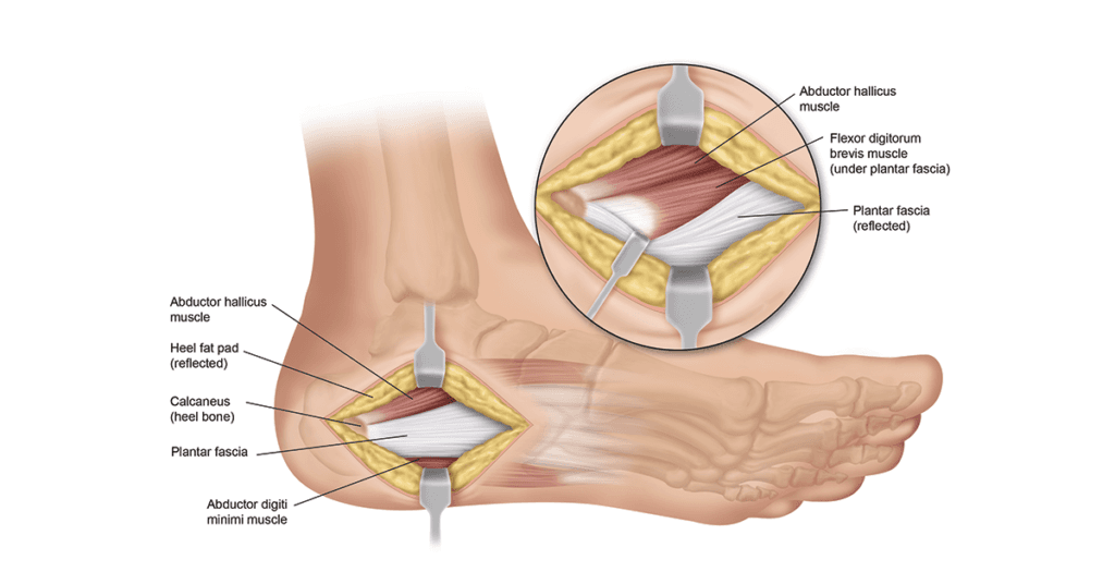 Illustration of Plantar Fascia Surgery