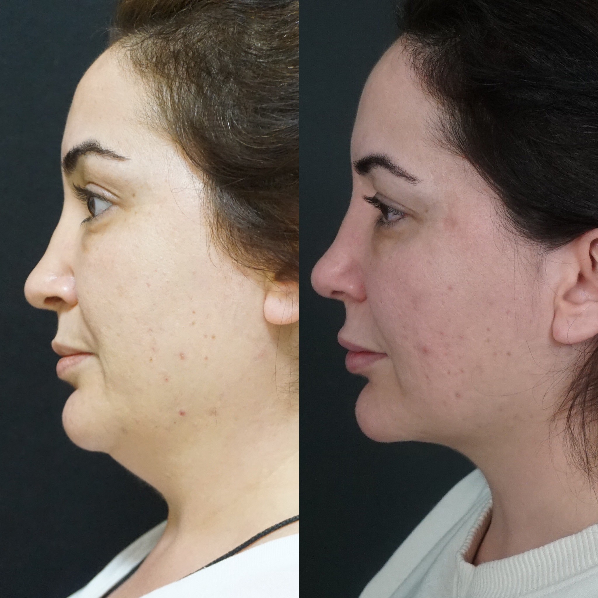 5 month post-surgery buccal fat removal before after with double chin liposuction