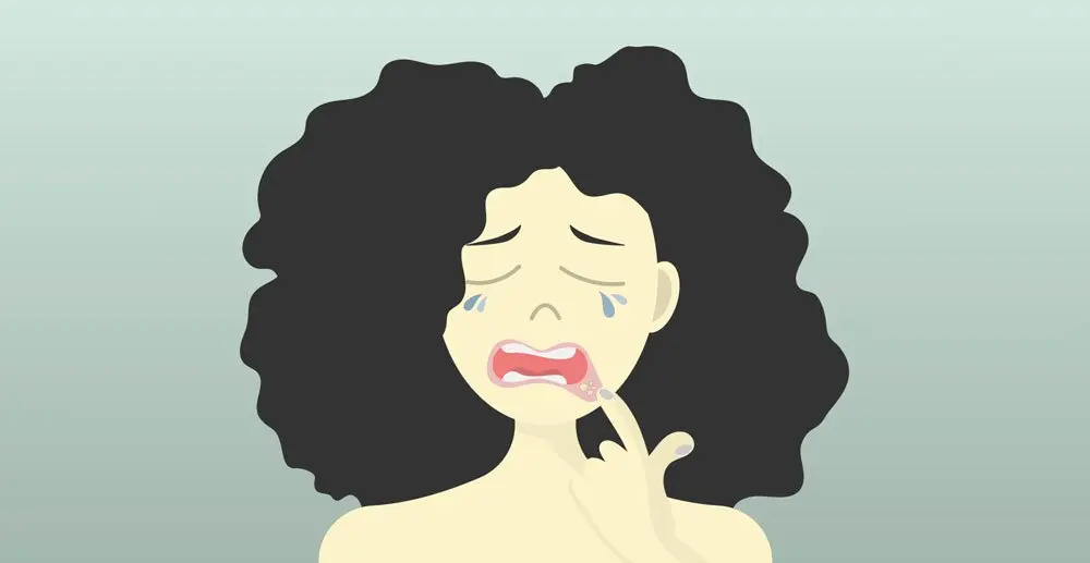 O que são as aftas? Como prevenir e tratá-las