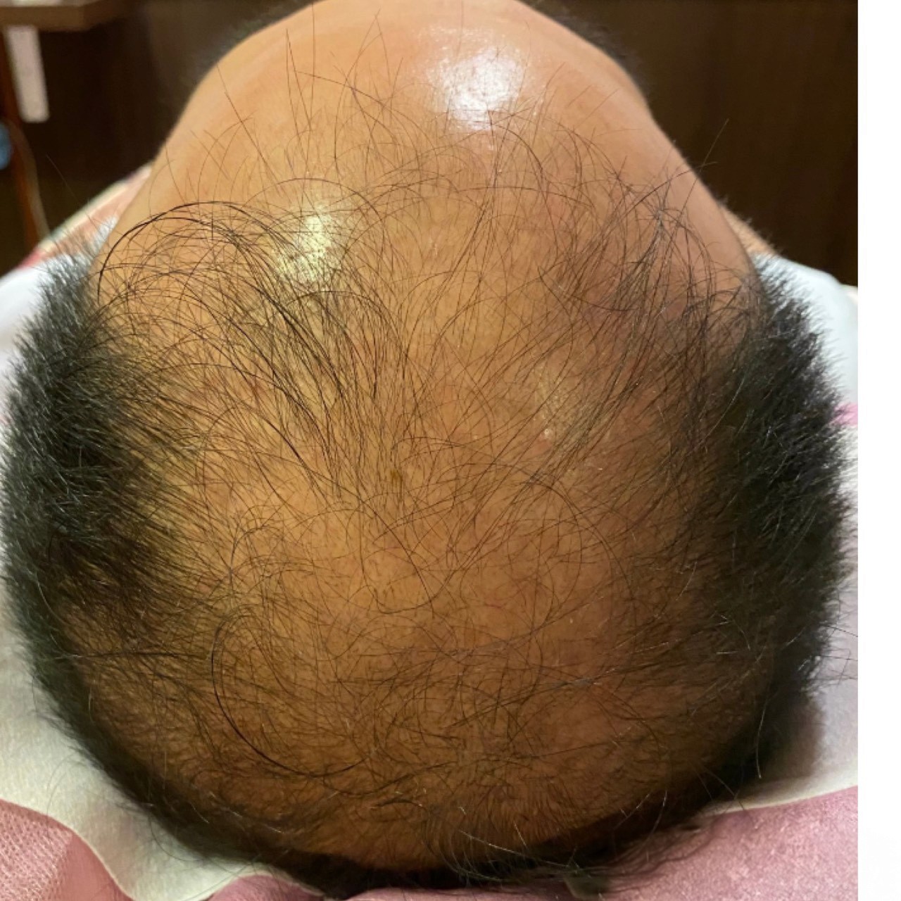 禿髮處理前