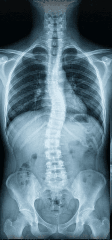 Radiografia panorâmica de coluna total em posição ortostática evidenciando escoliose.