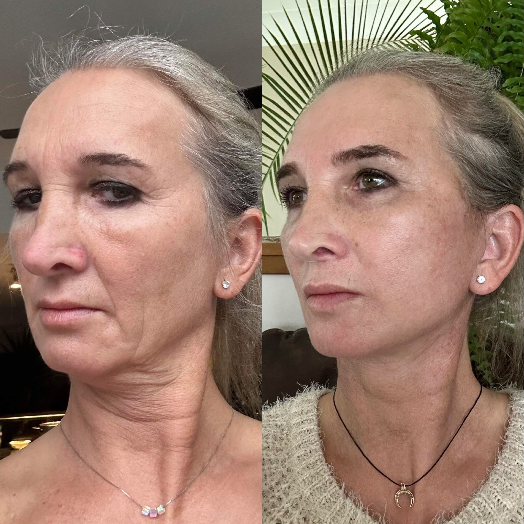 2 months post-op deep plane face neck lift and browlift before after left oblique view