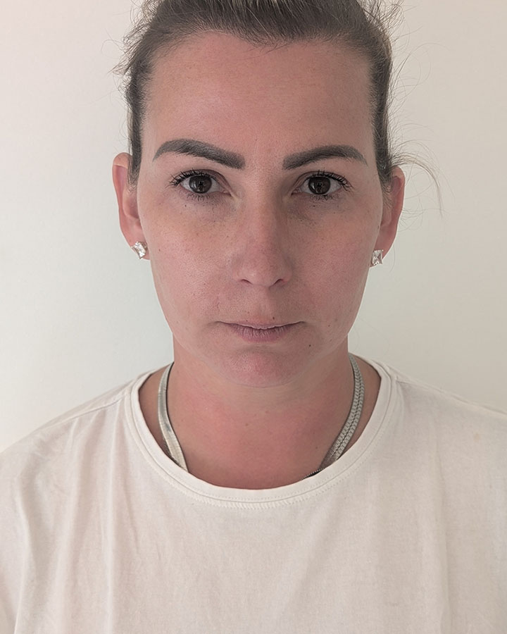 Unavený vzhľad tváre s kruhmi pod očami a ochabnutou spodnou časťou pred ošetrením