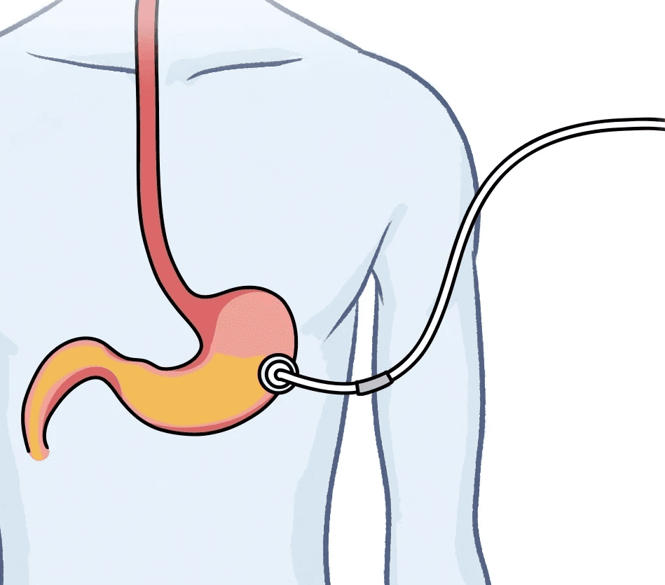 위루관 일러스트