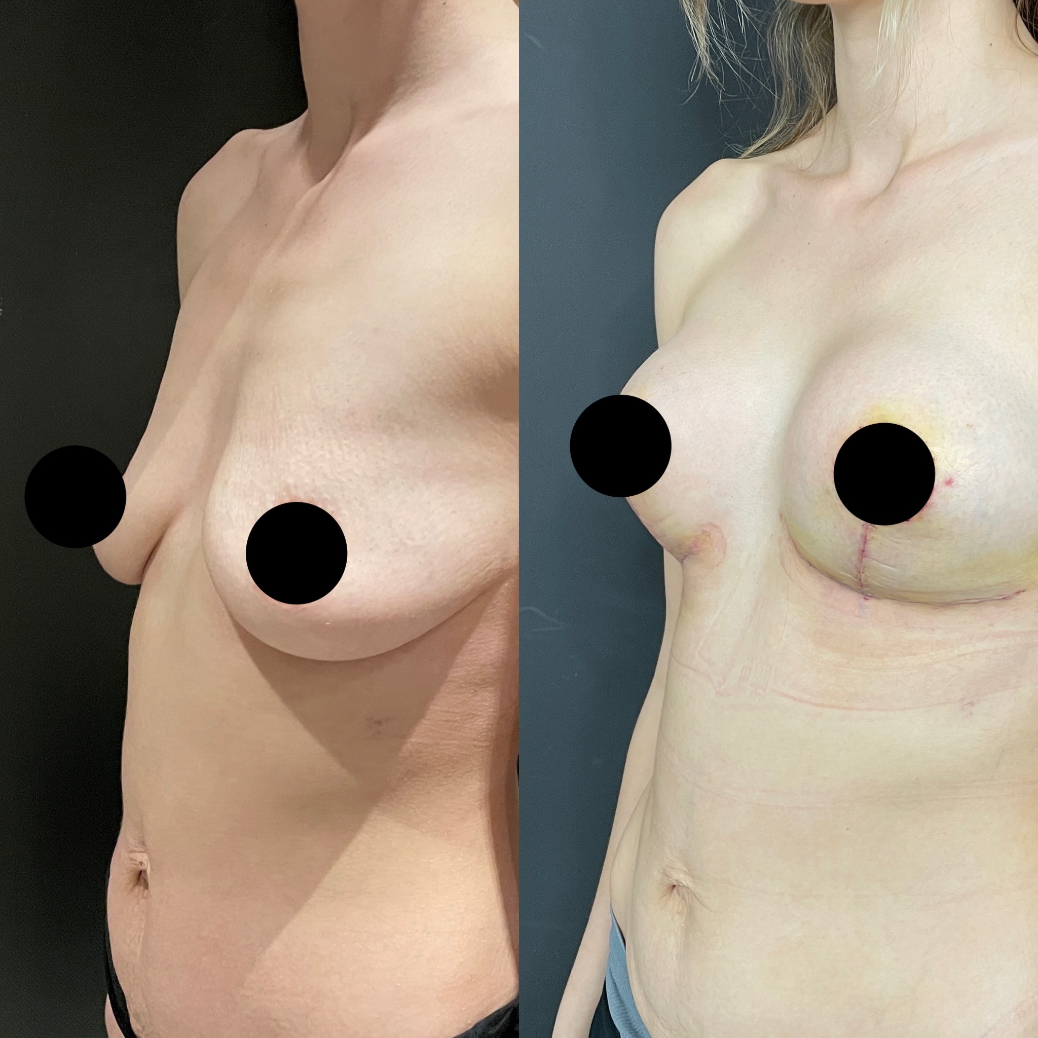 6th day before after breast lift with implant oblique view2