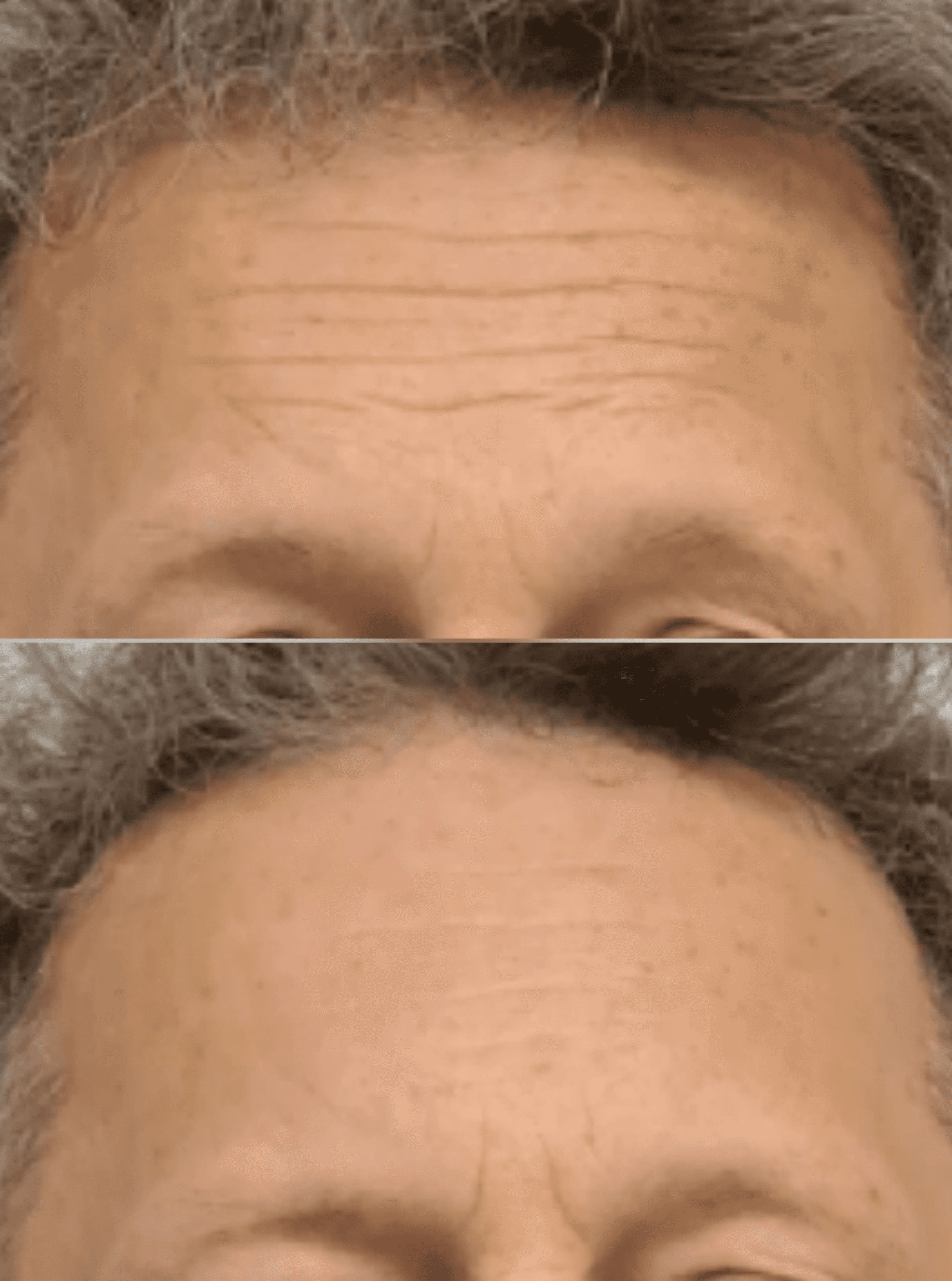 Neurolifting efekt_jednego_spotkania_szczecin_leszczenko_neurorehabilitacja_zabiegi_zamiast_botoksu