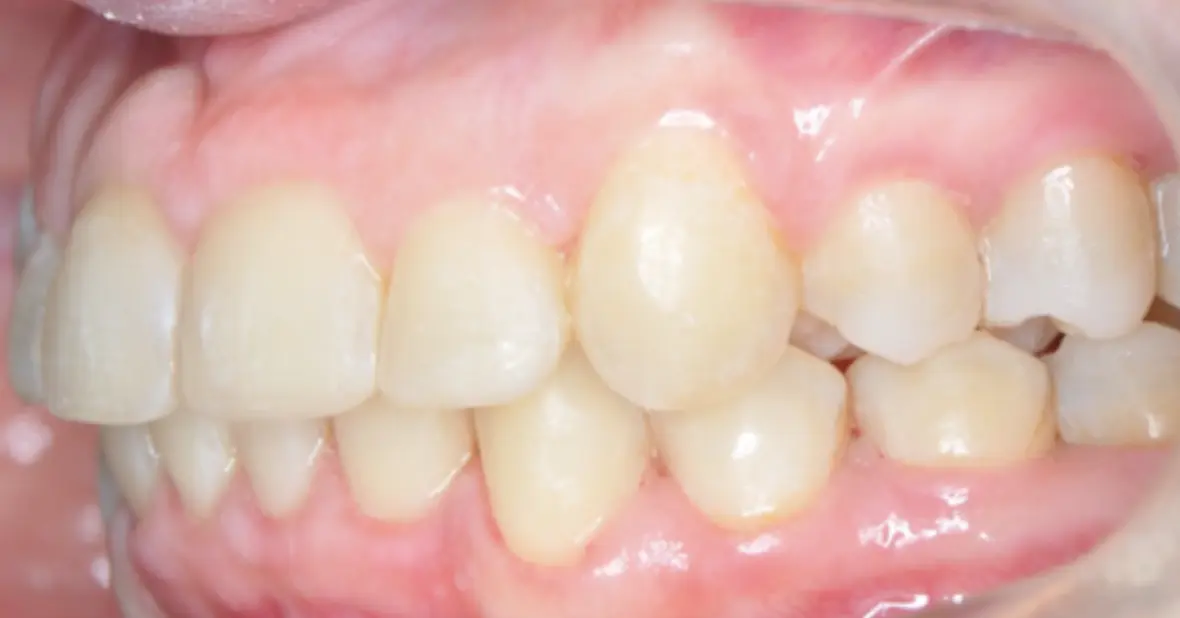 Prima e dopo il trattamento ortodontico funzionale, senza estrazione dei denti premolari