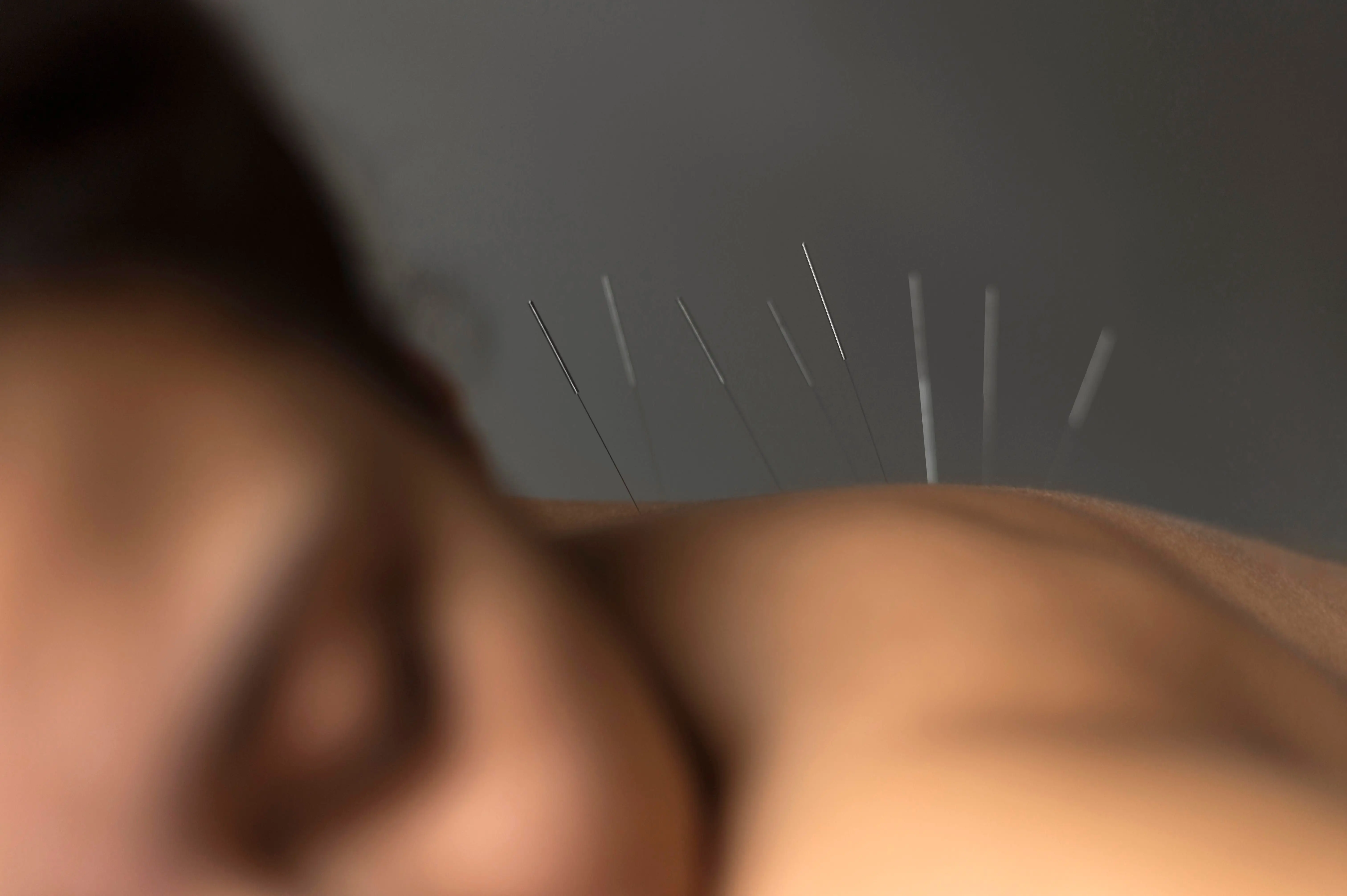 The Top 5 Benefits of Acupuncture for Women