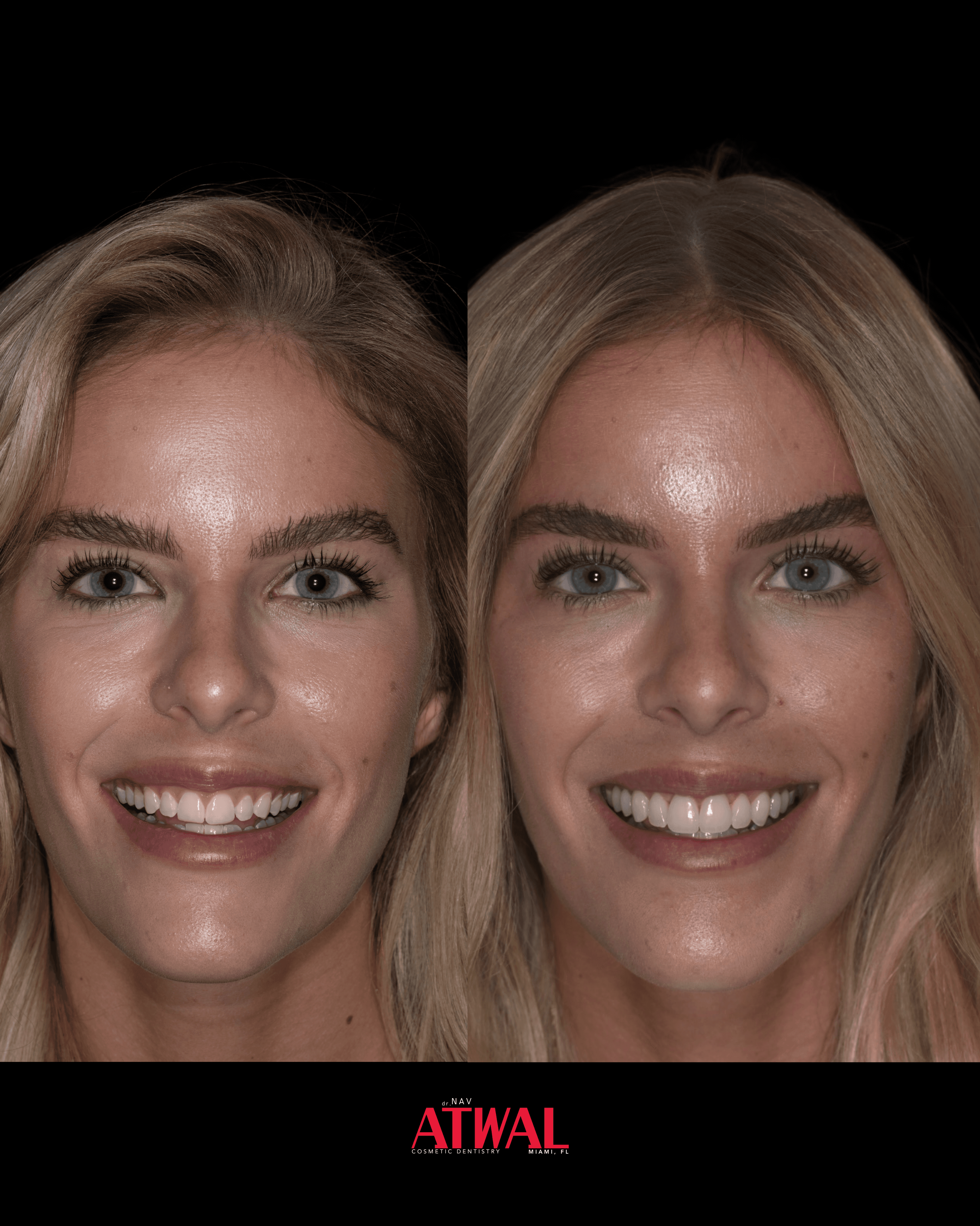 Hand Crafted Customized Veneers, 10 units — natural smile makeover, MiamiTwo crowns and two 