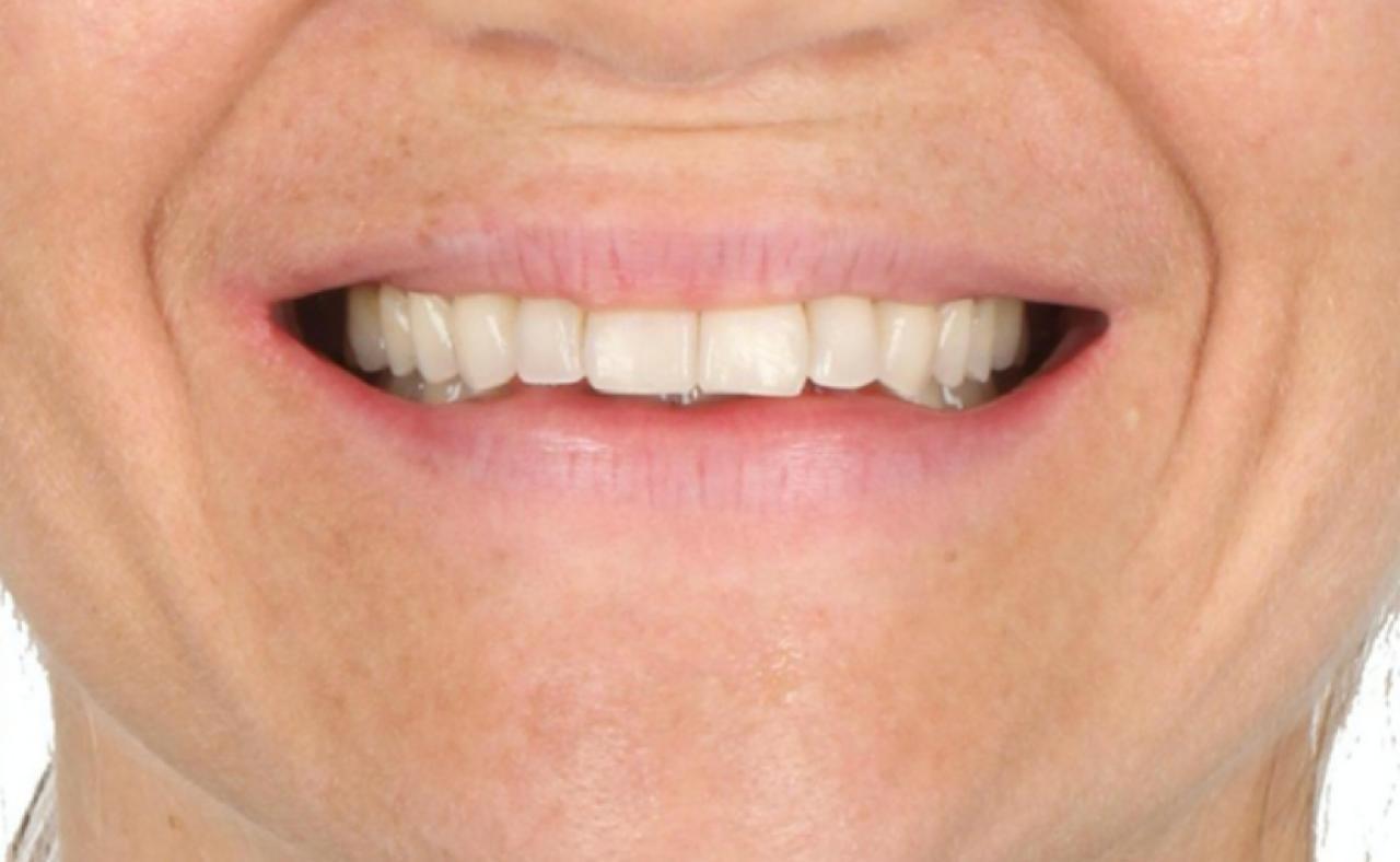 Antes do tratamento com alinhadores