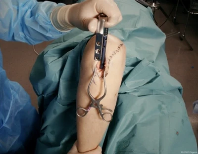 Intramedullary nailing of the tibia