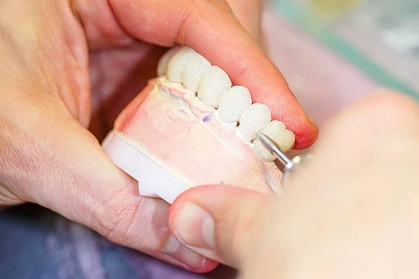 Dental Crown Lengthening in Toronto | Bloor-Yorkville Periodontics