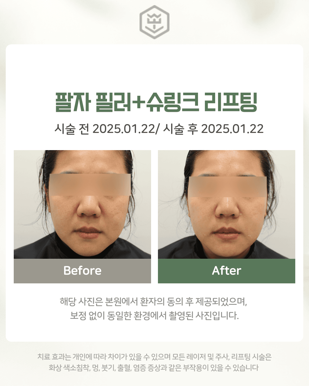 팔자필러+슈링크리프팅