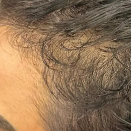 Before growth factors hair treatment at The Vancouver Aesthetician — receding hairline and thinning hair with dormant follicles visible on scalp