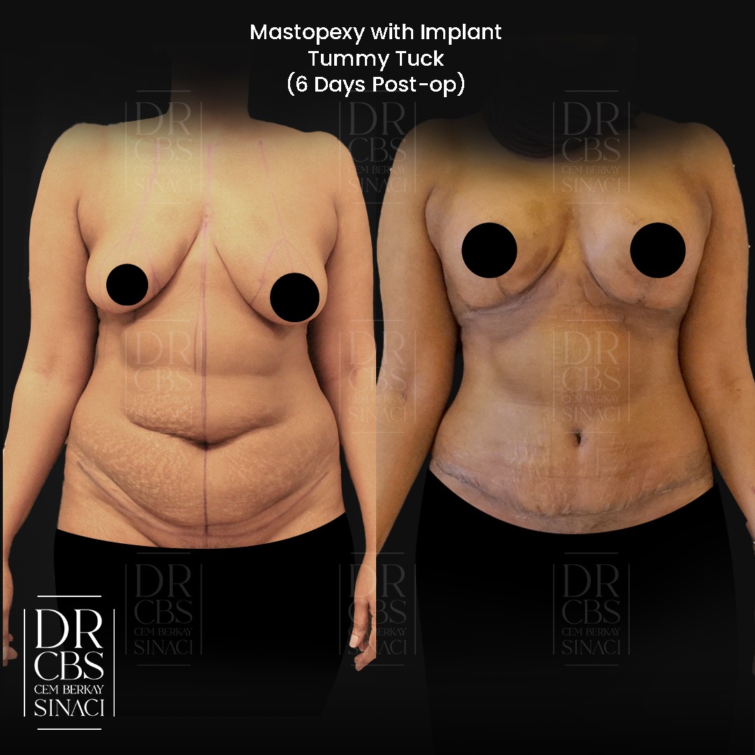 mommy makeover result breast lift with implant and tummy tuck before after front view