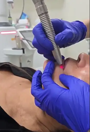 Practitioner applying laser acne treatment to patient's cheek.
