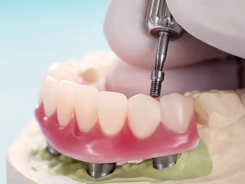 all-on-4 dental implants