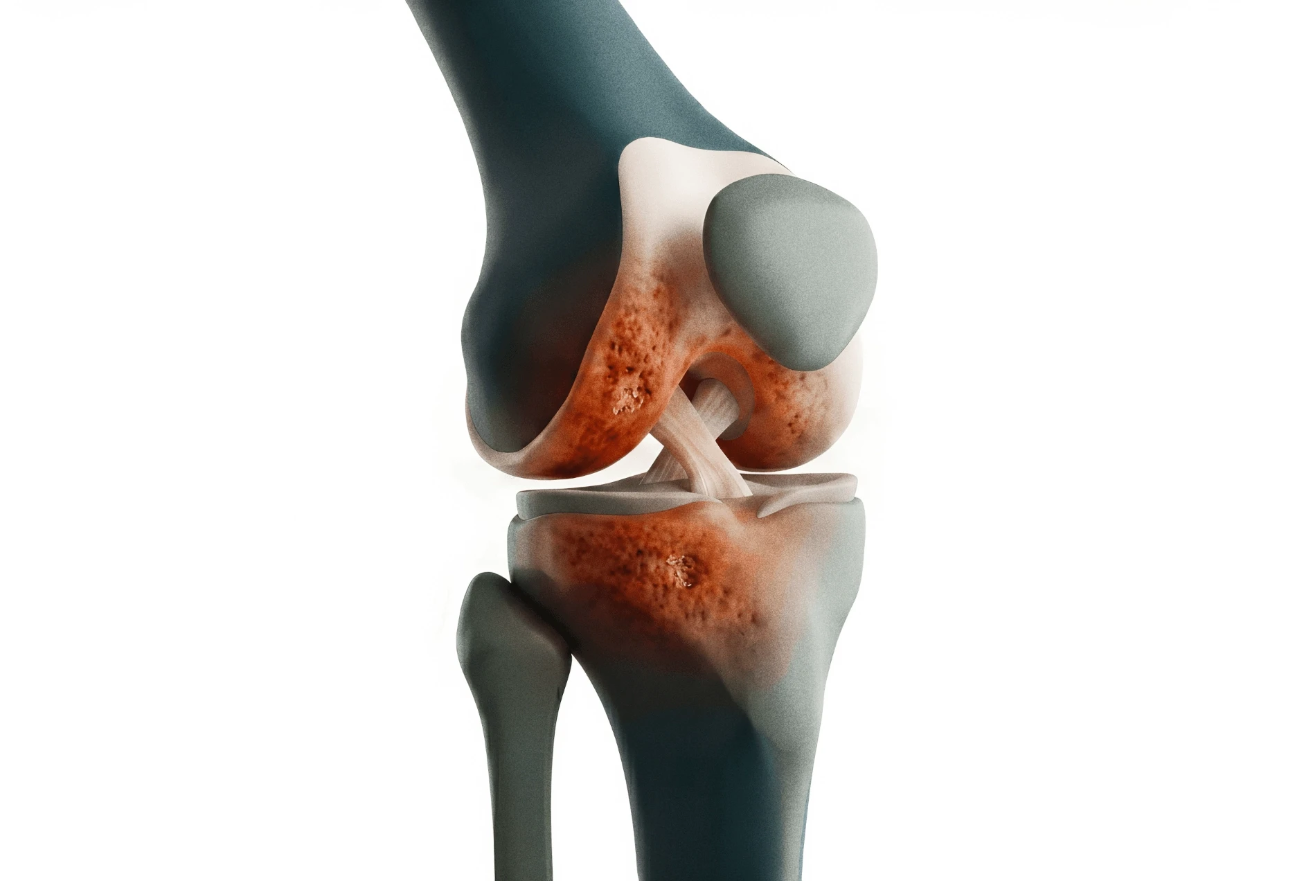 Child Osteomyelitis