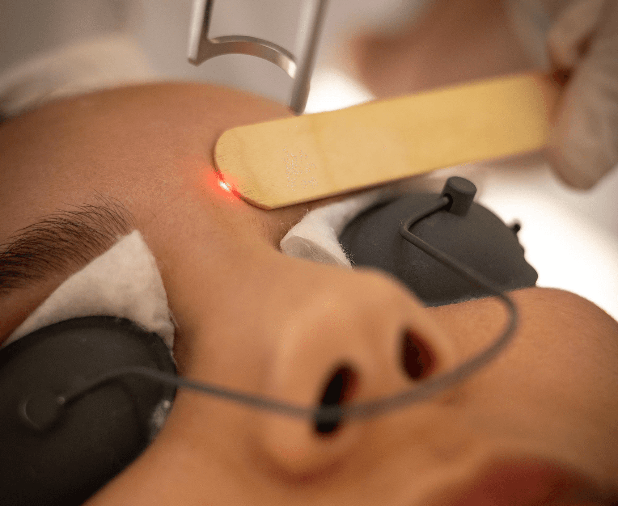Technologies used for different types of laser hair removal