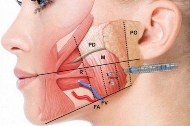 Tiêm botox gọn hàm giúp cải thiện khuôn mặt V-line hơn