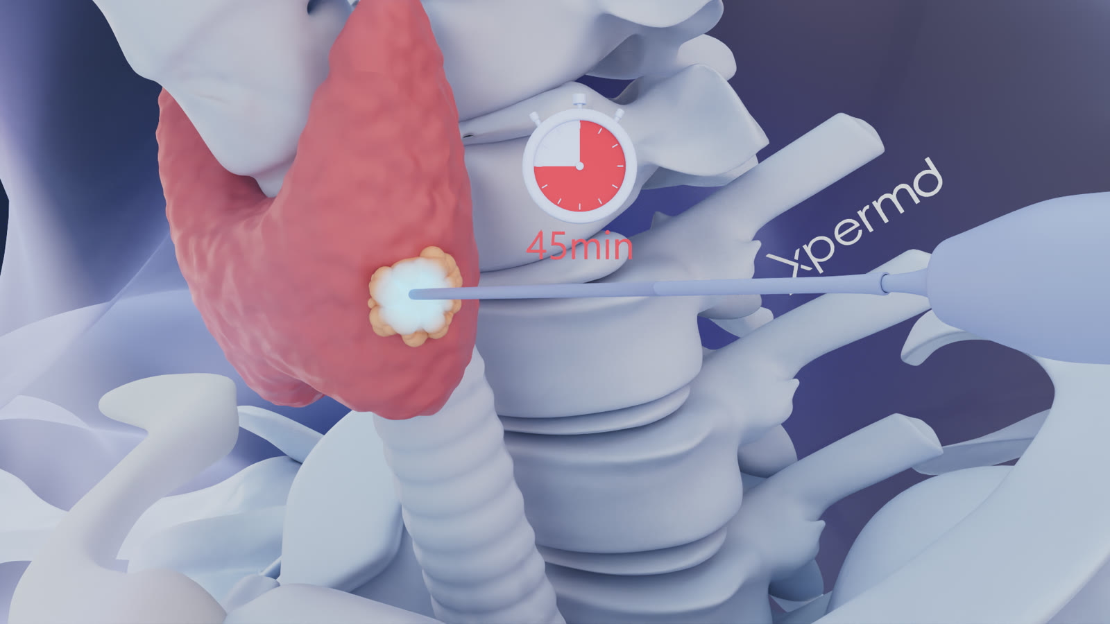 Animation 3D de la thermoablation d’un nodule thyroïdien