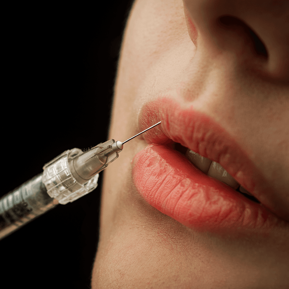 injection of lip filler hyaluronic acid