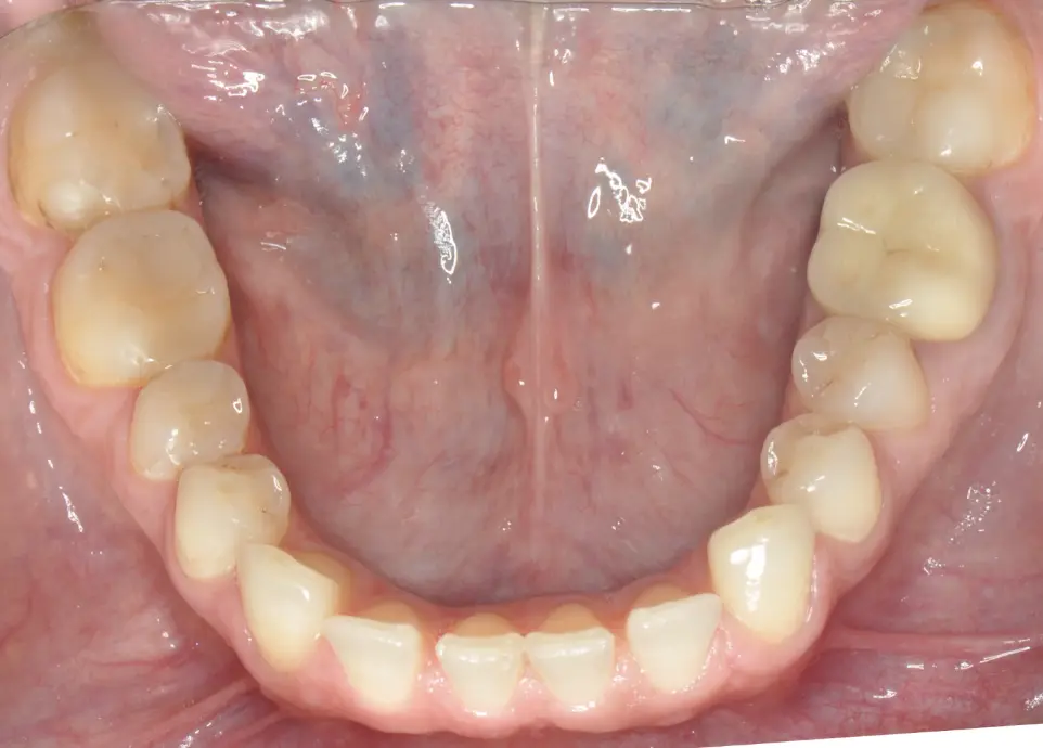 &nbsp;&nbsp;Before ortho treatment