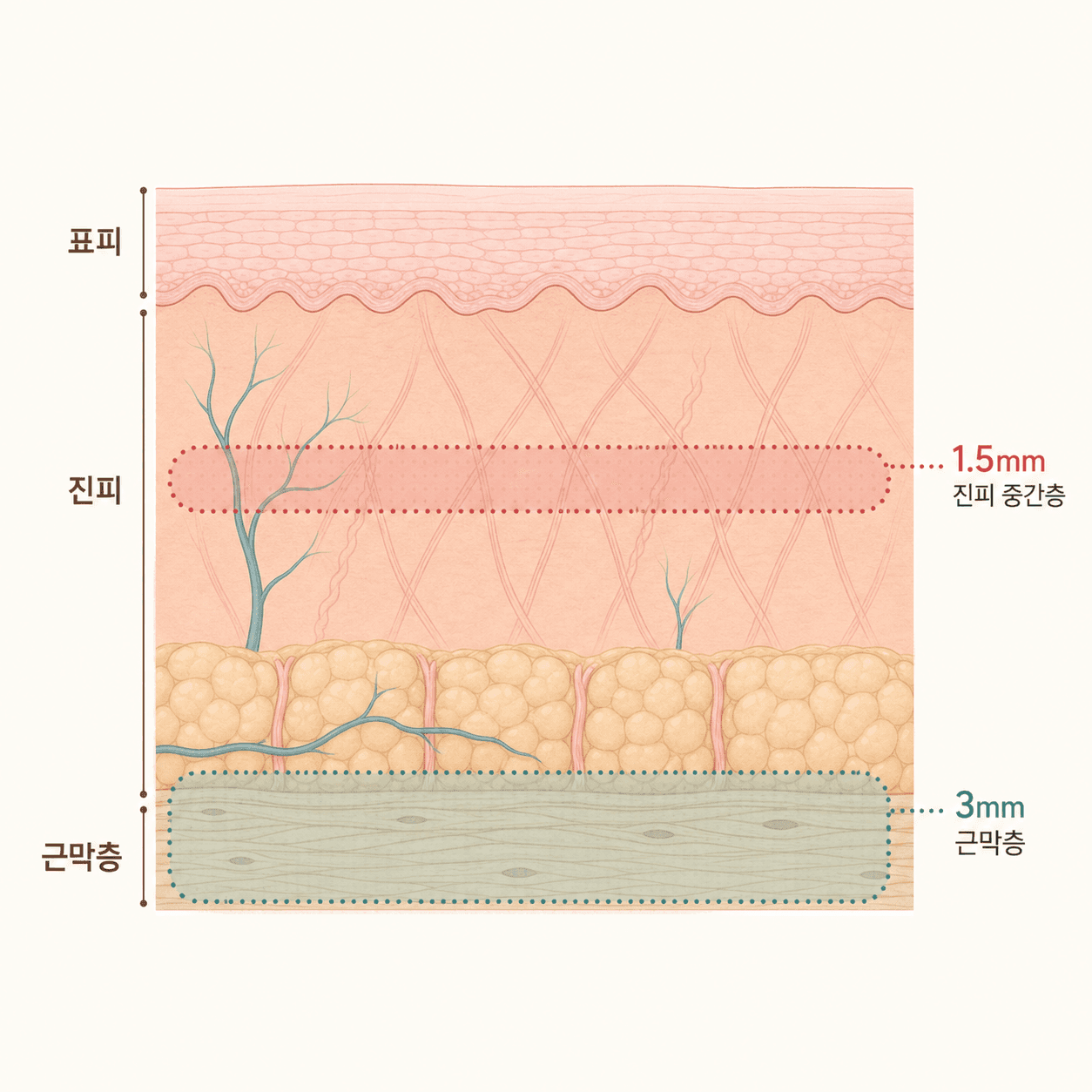 진피 중간층과 깊은 근막층, 서로 다른 초음파 깊이